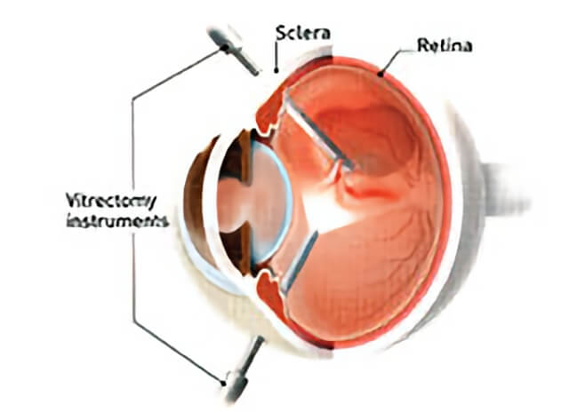 macular hole